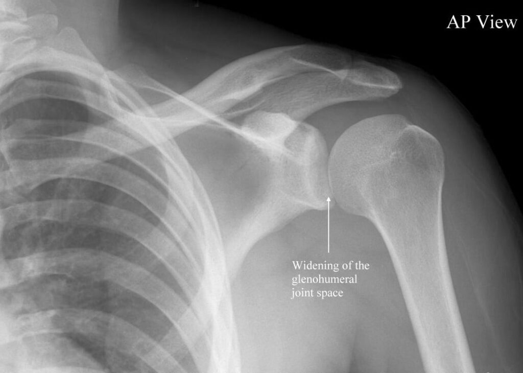 shoulder dislocation