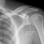 shoulder dislocation